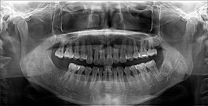Dental X-ray Scan